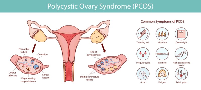 PCOS symptoms
